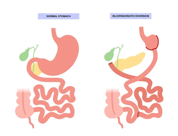 Biliopancreatic Diversion Gastroplasty Bpd Stomach Surgery Weight Loss Gastric Procedure — Stock Vector