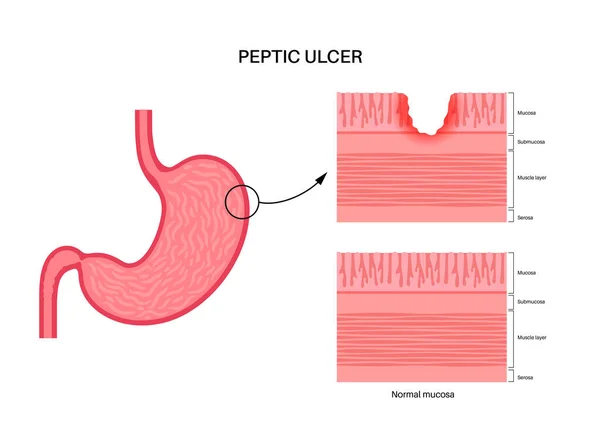 Peptic Ulcer Disease Sore Wall Stomach Abdomen Pain Human Body — Stock Vector