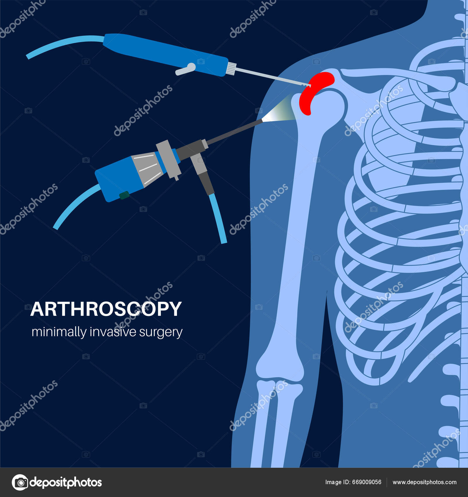 Shoulder Arthroscopy Procedure Rotator Cuff Tears Shoulder Impingement