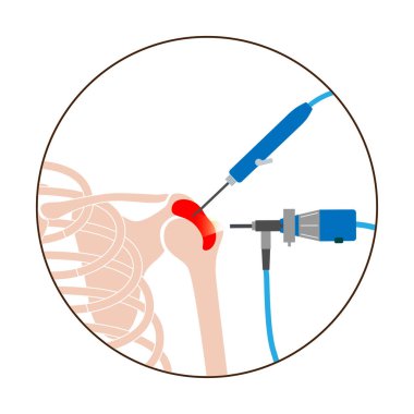 Omuz artroskopisi prosedürü. Subacromial dekompresyon, bursitis veya omuz eklemi değişimi. Minimum invaziv ameliyat. İnsan vücudunda ağrı veya eklem iltihabı. Tıbbi vektör illüstrasyonunda.