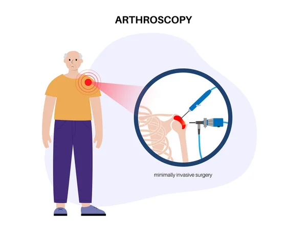 Shoulder Arthroscopy Procedure Elderly Man Rotator Cuff Tears Shoulder Joint — Stock Vector