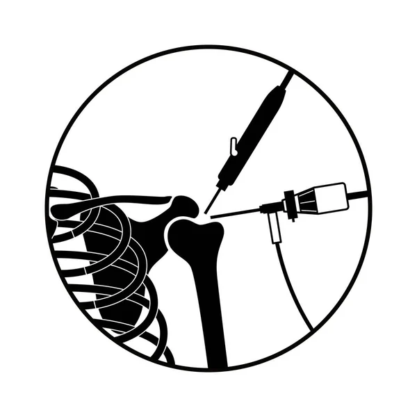 Shoulder Arthroscopy Procedure Rotator Cuff Tears Shoulder Joint Replacement Minimally — Stock Vector