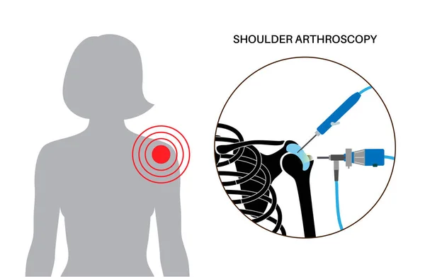 Shoulder Arthroscopy Procedure Rotator Cuff Tears Shoulder Impingement Minimally Invasive — Stock Vector