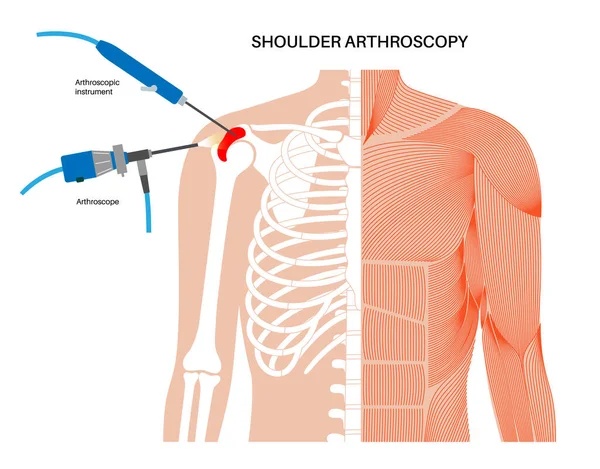 Shoulder Arthroscopy Procedure Rotator Cuff Tears Shoulder Muscles Problem Minimally — Stock Vector