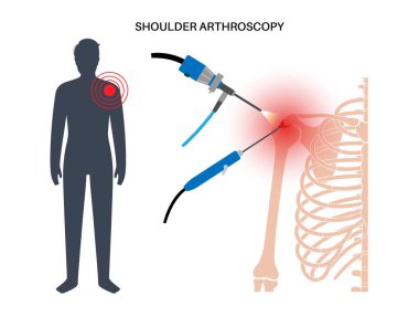 Omuz artroskopisi prosedürü. Subacromial dekompresyon, bursitis veya omuz eklemi değişimi. Minimum invaziv ameliyat. İnsan vücudunda ağrı veya eklem iltihabı. Tıbbi vektör illüstrasyonunda.