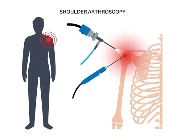 Shoulder Arthroscopy Procedure Subacromial Decompression Bursitis Shoulder Joint Replacement Minimally — Stock Vector