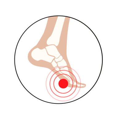 Şeker hastası ayak sendromu ikonu. Ülser, açık yara ya da ayak yarası. Bağlarda, tendonda ve kemiklerde iltihaplanma. Kangren enfeksiyonu ve ampütasyon. Bacak ağrısı, teşhis ve tedavi vektörü.