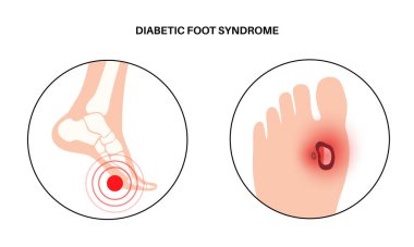 Diabetic foot syndrome. Deep ulcer, open sore or wound on the feet. Inflammation in the ligaments, tendon and bones. Gangrene infection and amputation. Pain in leg, diagnostic and treatment vector clipart