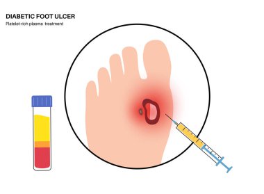 Trombosit zengini plazmayla diyabetik ayak sendromu tedavisi. PRP enjeksiyon konsepti. Ülser, açık yara ya da ayakta yara. Deri ve bağlarda iltihap. Bacağında ağrı ve enfeksiyon var.