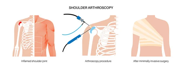 Shoulder Arthroscopy Procedure Rotator Cuff Tears Shoulder Muscles Problem Minimally — Stock Vector