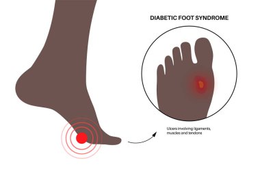 Diyabetik ayak sendromu. Ülser, açık yara ya da ayakta yara. Bağlarda, tendonda ve kemiklerde iltihaplanma. Kangren enfeksiyonu ve ampütasyon. Bacak ağrısı, teşhis ve tedavi vektörü