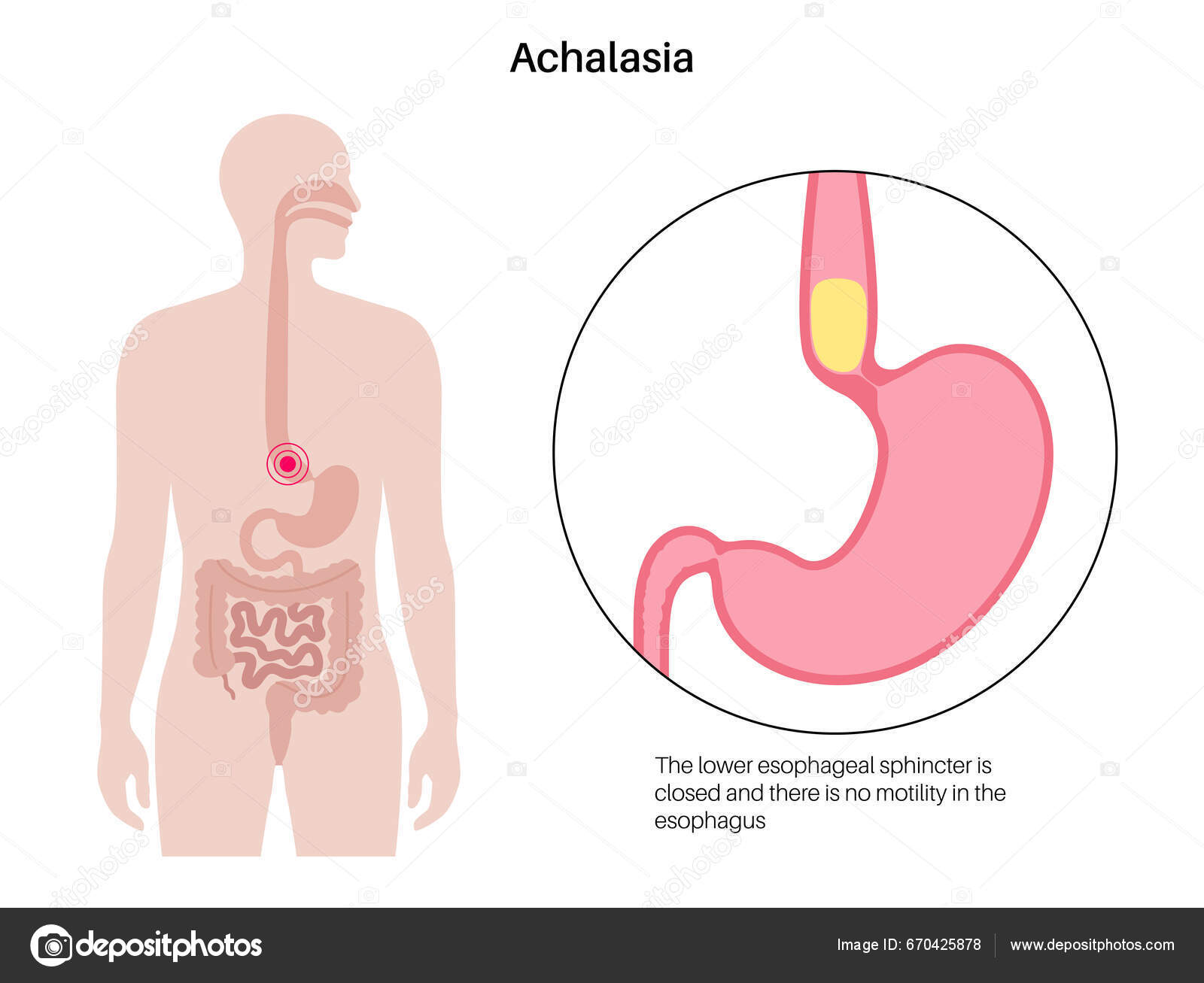 Esofageal Akalasi Medicinsk Affisch Misslyckande Glatta Muskelfibrer