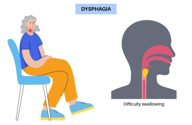 Esophageal achalasia tıbbi afişi. Rahatlamak için yumuşak kas liflerinin bozulması. Gastrobağırsak yolu hastalığı. Kapalı özofajiyal sfinkter, sindirim sistemi bozukluğu düz vektör çizimi.