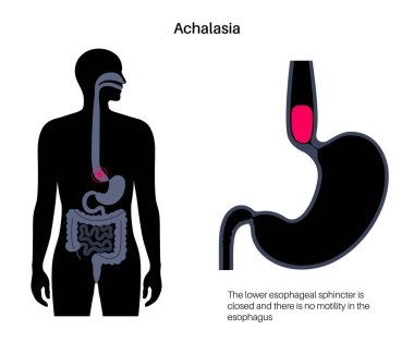 Esophageal achalasia tıbbi afişi. Rahatlamak için yumuşak kas liflerinin bozulması. Gastrobağırsak yolu hastalığı. Kapalı özofajiyal sfinkter, sindirim sistemi bozukluğu düz vektör çizimi.