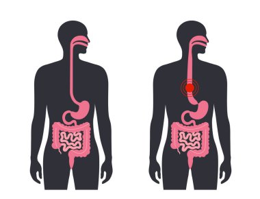 Esophageal achalasia tıbbi afişi. Rahatlamak için yumuşak kas liflerinin bozulması. Gastrobağırsak yolu hastalığı. Kapalı özofajiyal sfinkter, sindirim sistemi bozukluğu düz vektör çizimi.