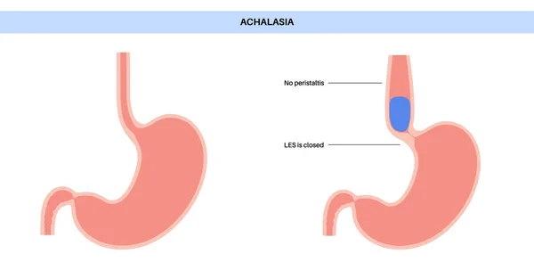Affiche Médicale Sur Achalasie Oesophagienne Défaut Relâchement Des Fibres Musculaires — Image vectorielle