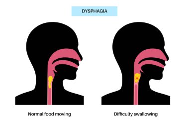 Dysphagia medical poster. Difficult or painful swallowing. Esophagus disease concept. Difficulty in the passage of solids or liquids from the mouth to the stomach. Digestive tract problem flat vector clipart