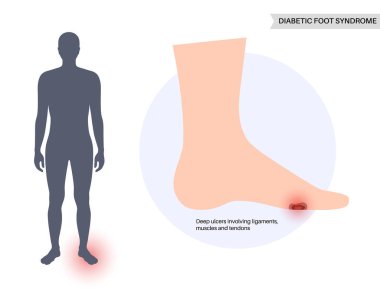 Diyabetik ayak sendromu. Ülser, açık yara ya da ayakta yara. Bağlarda, tendonda ve kemiklerde iltihaplanma. Kangren enfeksiyonu ve ampütasyon. Bacak ağrısı, teşhis ve tedavi vektörü