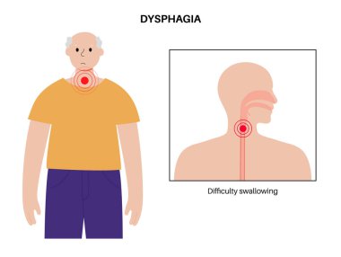 Esophageal achalasia tıbbi afişi. Rahatlamak için yumuşak kas liflerinin bozulması. Gastrobağırsak yolu hastalığı. Kapalı özofajiyal sfinkter, sindirim sistemi bozukluğu düz vektör çizimi.