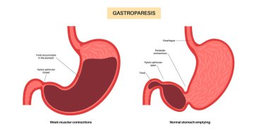 Gastroparezi bozukluğu. Gastrik boşaltma konsepti gecikti. Mide kasılmaları. Bulantı, kusma, insan vücudunda karın ağrısı. Sindirim sistemi düz vektör çizimi hastalıkları.