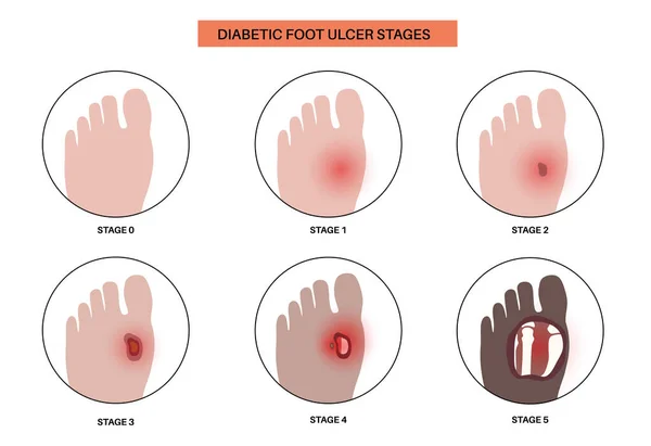 stock vector Diabetic foot syndrome stages. Deep ulcer, open sore or wound on feet. Inflammation in the ligaments, tendon and bones. Gangrene infection and amputation. Pain in leg, diagnostic and treatment vector.