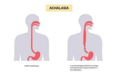 Esophageal achalasia tıbbi afişi. Rahatlamak için yumuşak kas liflerinin bozulması. Gastrobağırsak yolu hastalığı. Kapalı özofajiyal sfinkter, sindirim sistemi bozukluğu düz vektör çizimi.