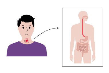 Disfaji tıbbi afişi. Zor ya da acı verici bir yutkunma. Yemek borusu hastalığı konsepti. Katı maddelerin ya da sıvıların ağızdan mideye geçmesinde sorun var. Sindirim sistemi sorunu düz vektörü