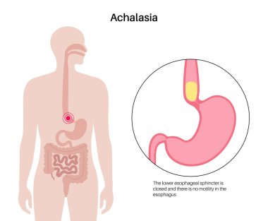 Esophageal achalasia tıbbi afişi. Rahatlamak için yumuşak kas liflerinin bozulması. Gastrobağırsak yolu hastalığı. Kapalı özofajiyal sfinkter, sindirim sistemi bozukluğu düz vektör çizimi.