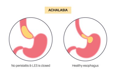 Esophageal achalasia tıbbi afişi. Rahatlamak için yumuşak kas liflerinin bozulması. Gastrobağırsak yolu hastalığı. Kapalı özofajiyal sfinkter, sindirim sistemi bozukluğu düz vektör çizimi.