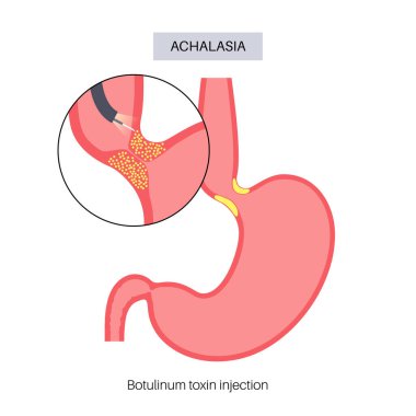 Esophageal akhalasia hastalığı, botulinum toksin enjeksiyon tedavisi. Rahatlamak için yumuşak kas liflerinin bozulması. Gastrobağırsak sistemi bozukluğu. Kapalı özofajiyal sfinkter, sindirim sistemi vektörü