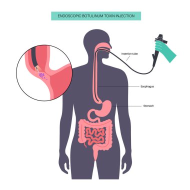 Esophageal akhalasia hastalığı, botulinum toksin enjeksiyon tedavisi. Rahatlamak için yumuşak kas liflerinin bozulması. Gastrobağırsak sistemi bozukluğu. Kapalı özofajiyal sfinkter, sindirim sistemi vektörü