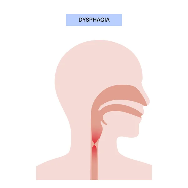 Dysphagia医疗海报 吞咽困难或痛苦的吞咽食管癌的概念 固体或液体从口中进入胃部的困难 消化道问题平面矢量 — 图库矢量图片