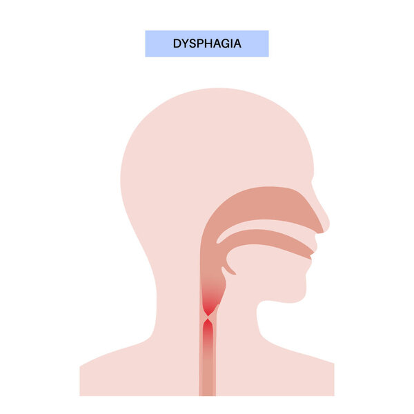 Dysphagia medical poster. Difficult or painful swallowing. Esophagus disease concept. Difficulty in the passage of solids or liquids from the mouth to the stomach. Digestive tract problem flat vector