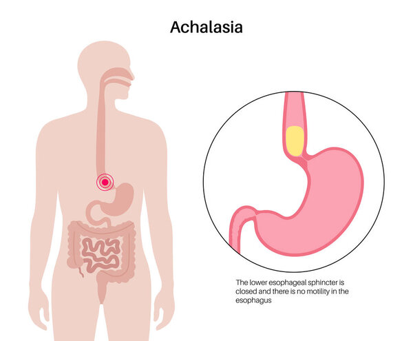 Esophageal achalasia medical poster. Failure of smooth muscle fibers to relax. Gastrointestinal tract disease. Closed lower esophageal sphincter, digestive system disorder flat vector illustration.