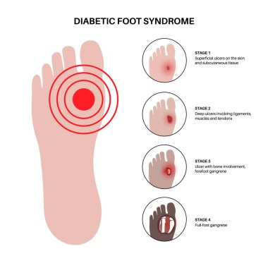 Diabetic foot syndrome stages. Deep ulcer, open sore or wound on feet. Inflammation in the ligaments, tendon and bones. Gangrene infection and amputation. Pain in leg, diagnostic and treatment vector. clipart