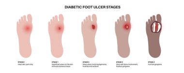 Diabetic foot syndrome stages. Deep ulcer, open sore or wound on feet. Inflammation in the ligaments, tendon and bones. Gangrene infection and amputation. Pain in leg, diagnostic and treatment vector. clipart