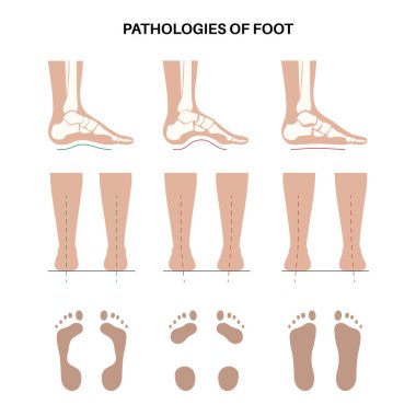Ayak patolojisi anatomik poster. Düz, normal ve içi boş ayak koşulları. Anormal ayak kemeri, süsleme ve aşırı telaffuz. Ayak bileği patolojisi podiyatri kliniğinde tıbbi vektör çizimi.