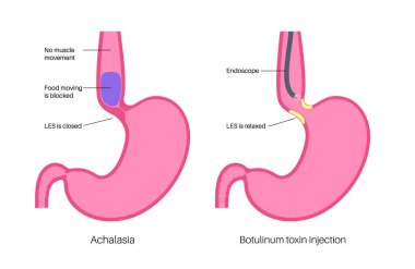 Esophageal akhalasia hastalığı, botulinum toksin enjeksiyon tedavisi. Rahatlamak için yumuşak kas liflerinin bozulması. Gastrobağırsak sistemi bozukluğu. Kapalı özofajiyal sfinkter, sindirim sistemi vektörü