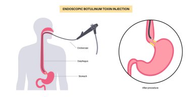 Esophageal akhalasia hastalığı, botulinum toksin enjeksiyon tedavisi. Rahatlamak için yumuşak kas liflerinin bozulması. Gastrobağırsak sistemi bozukluğu. Kapalı özofajiyal sfinkter, sindirim sistemi vektörü