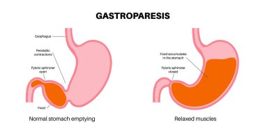 Gastroparezi bozukluğu. Gastrik boşaltma konsepti gecikti. Mide kasılmaları. Bulantı, kusma, insan vücudunda karın ağrısı. Sindirim sistemi düz vektör çizimi hastalıkları.
