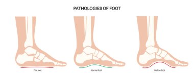 Ayak patolojisi anatomik poster. Düz, normal ve içi boş ayak koşulları. Anormal ayak kemeri, süsleme ve aşırı telaffuz. Ayak bileği patolojisi podiyatri kliniğinde tıbbi vektör çizimi.