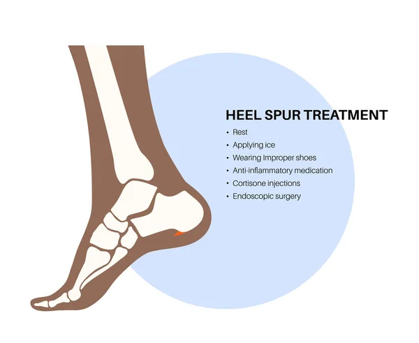Calcaneal Spur Treatment Foot Problem Diagnostic Consult Podiatry Clinic Heel — Stock Vector