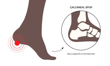 Calcaneal spur anatomisi. Ayak problemi, teşhis ve pediatri kliniğinde tedavi. Kalkaneal tüberkülozdan topuk kemiği büyümüş. Ayak bileği ağrısı ve şişkinlik. Ayak vektör illüstrasyonunun X ışını incelemesi