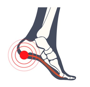 Pain of the heel anatomical poster. Ankle and foot diseases. Calcaneal spur, achilles tendinitis, plantar fascia strain or fasciitis treatment. Ankle bones and ligament medical vector illustration clipart