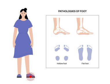 Ayak patolojisi anatomik poster. Düz ve içi boş ayak koşulları. Anormal ayak kemeri, süsleme ve aşırı deformasyon. Ayak bileği patolojisi tanısı klinik vektör illüstrasyonunda