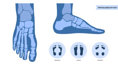 Ayak patolojisi anatomik poster. Düz, normal ve içi boş ayak koşulları. Anormal ayak kemeri, süsleme ve aşırı telaffuz. Ayak bileği patolojisi podiyatri kliniğinde tıbbi vektör çizimi.
