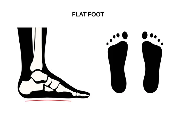 平足医疗海报 不正常的足弓状态 身体平衡问题 平足的概念 足底诊所的脚踝病理学诊断和治疗 — 图库矢量图片