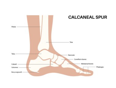 Calcaneal spur anatomisi. Ayak problemi, teşhis ve pediatri kliniğinde tedavi. Kalkaneal tüberkülozdan topuk kemiği büyümüş. Ayak bileği ağrısı ve şişkinlik. Ayak vektör illüstrasyonunun X ışını incelemesi