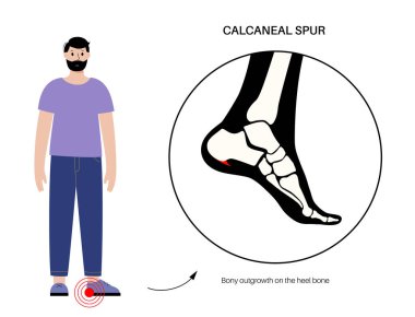 Calcaneal spur anatomisi. Ayak problemi, teşhis ve pediatri kliniğinde tedavi. Kalkaneal tüberkülozdan topuk kemiği büyümüş. Ayak bileği ağrısı ve şişkinlik. Ayak vektör illüstrasyonunun X ışını incelemesi