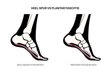 Calcaneal spur ve plantar fasciitis karşılaştırması. Ayak hastalıkları tedavisi. Topuk kemiği büyümesi ya da ayak bağları iltihaplanması. Ayak bileği ağrısı ve şişkinlik. X ışını incelemesi tıbbi düz vektör çizimi